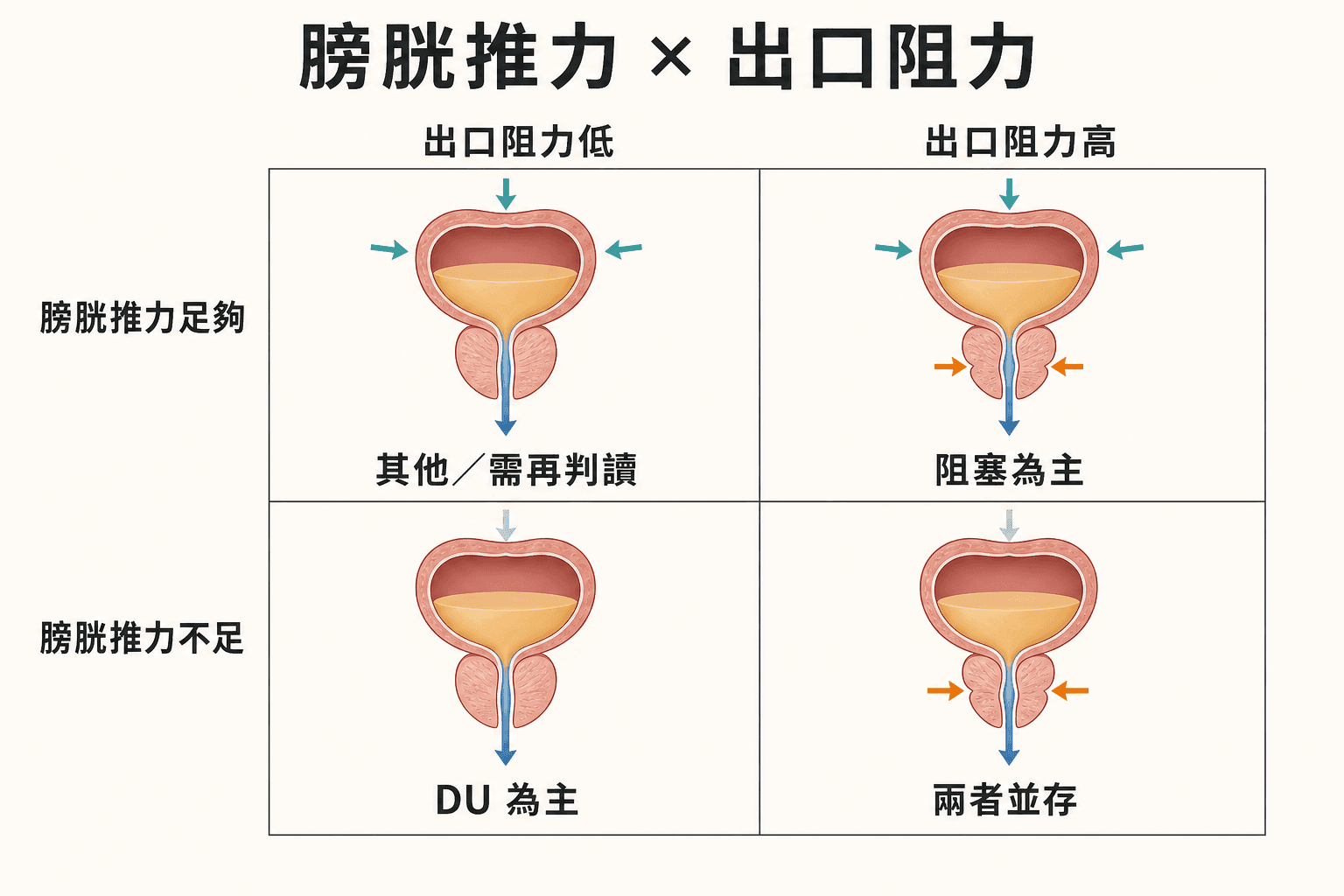 膀胱推力與出口阻力的四格矩陣,呈現阻塞為主、逼尿肌收縮力不足為主、兩者並存,以及其他需再判讀的情況。
